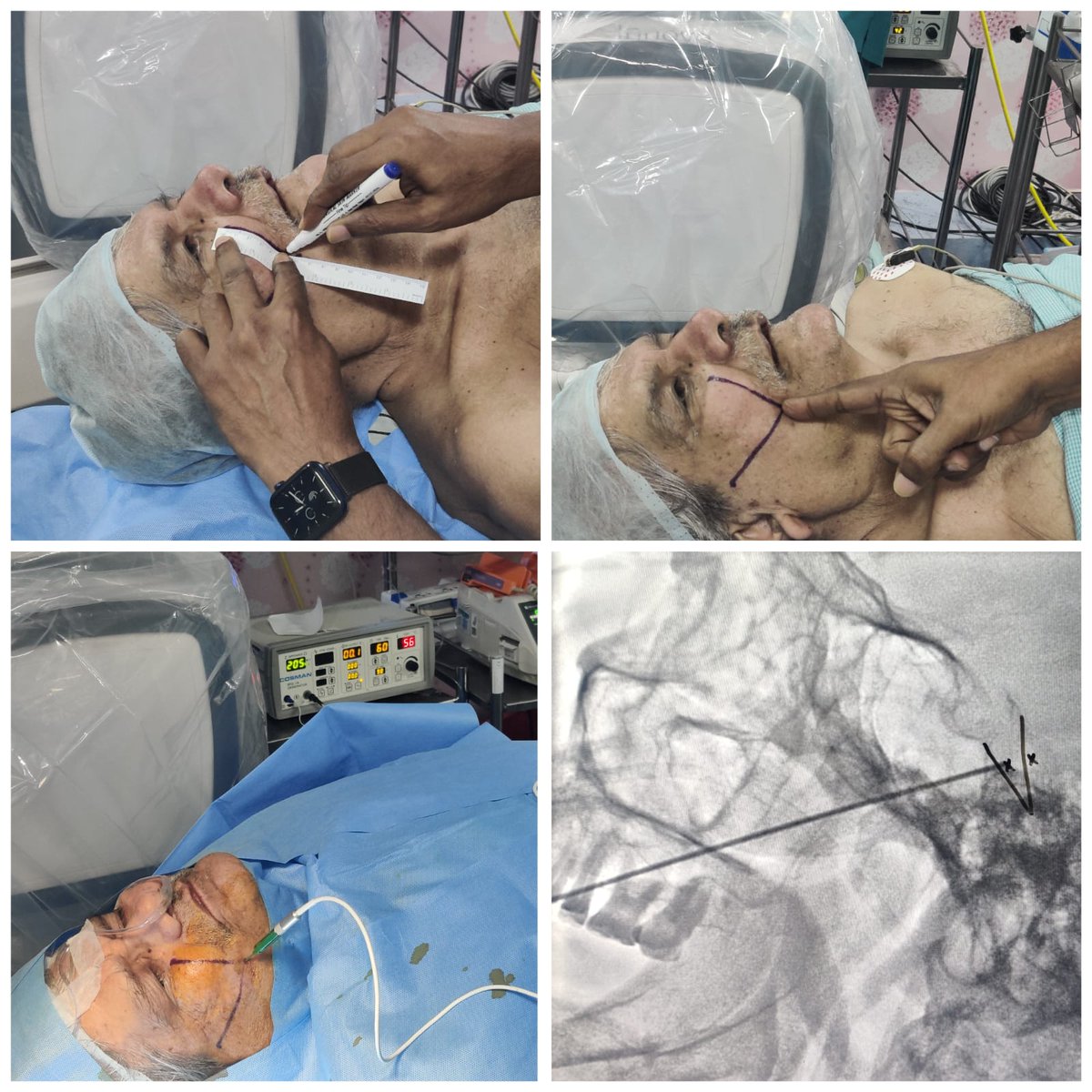 SharathKumarGG7's tweet image. Trigeminal RF Rhizotomy for failed MVD #Trigeminal #Neuralgia #RFablation #Rhizotomy #pain #Fluoroscopy #Neurosurgery