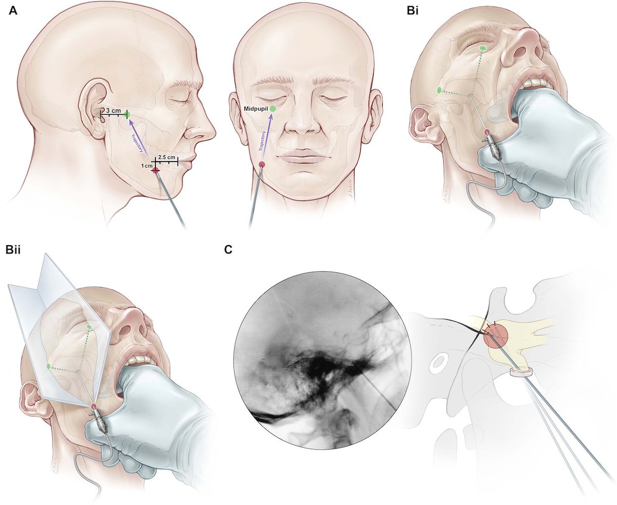 SharathKumarGG7's tweet image. Trigeminal RF Rhizotomy for failed MVD #Trigeminal #Neuralgia #RFablation #Rhizotomy #pain #Fluoroscopy #Neurosurgery