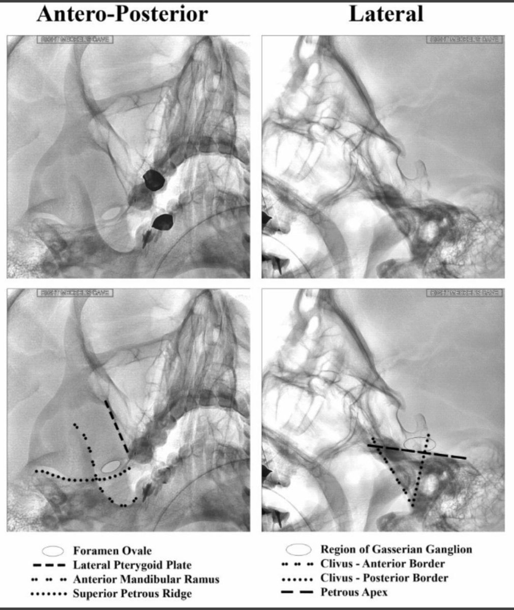 SharathKumarGG7's tweet image. Trigeminal RF Rhizotomy for failed MVD #Trigeminal #Neuralgia #RFablation #Rhizotomy #pain #Fluoroscopy #Neurosurgery
