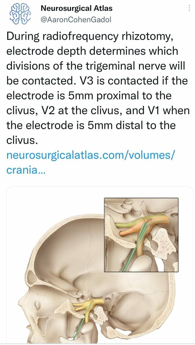SharathKumarGG7's tweet image. Trigeminal RF Rhizotomy for failed MVD #Trigeminal #Neuralgia #RFablation #Rhizotomy #pain #Fluoroscopy #Neurosurgery
