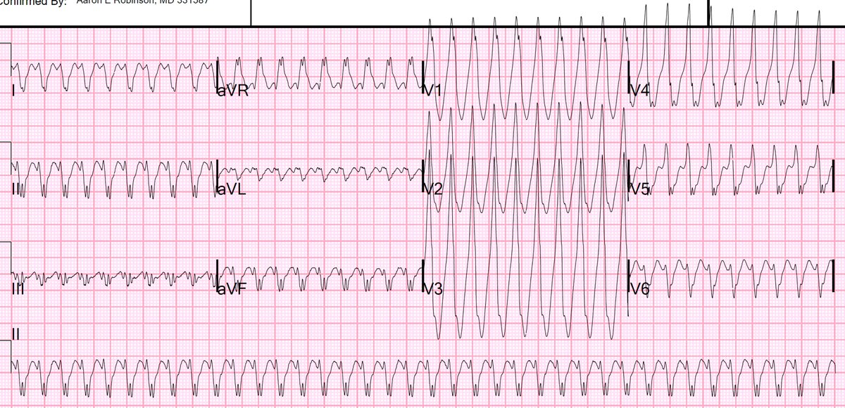 smithECGBlog's tweet photo. A 30-something with palpitations and lightheadedness
First: What do you want to do?
Next: What do you think is the ECG diagnosis?

https://t.co/iPpqaIh1Gk https://t.co/J4CPDMWDck
