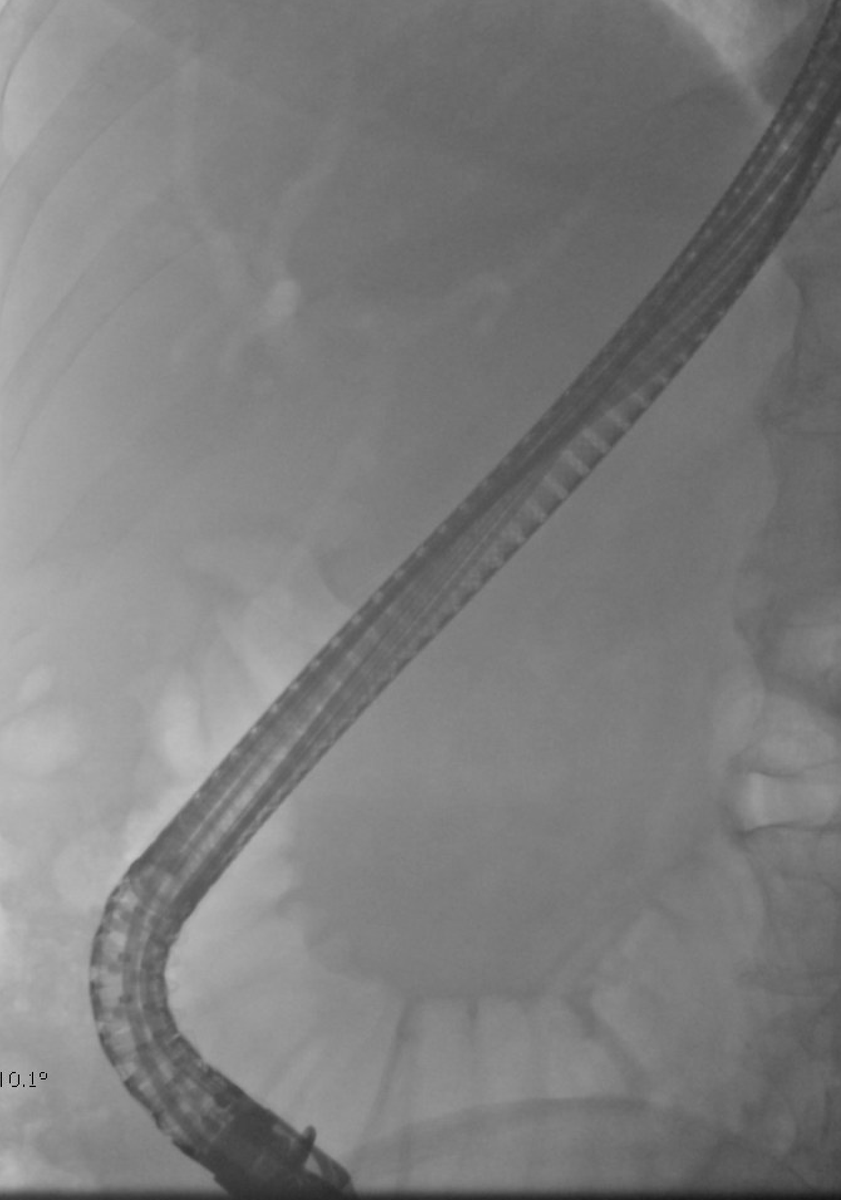 RKeswaniMD (@rkeswanimd) on Twitter photo It's an important habit for us to not just take scout films, but interpret them during ERCP. This patient had a distant history of a cholecystectomy, now with choledocholithiasis. No prior ERCP. What's unique about this scout film? <a href="/NM_IntEndo/">Northwestern Interventional Endoscopy</a> #GITwitter It's an important habit for us to not just take scout films, but interpret them during ERCP. This patient had a distant history of a cholecystectomy, now with choledocholithiasis. No prior ERCP. What's unique about this scout film? <a href="/NM_IntEndo/">Northwestern Interventional Endoscopy</a> #GITwitter