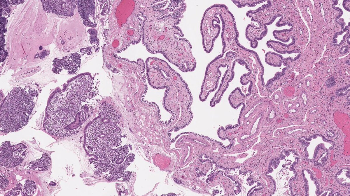 Drmerm's tweet photo. TUBAL ENDOMETRIOSIS
Endometriosis frequently involves the fallopian tube
it is seen in up to 10% of tubal resection specimens.
#PathTwitter #Medtwitter #pathology #gync https://t.co/eVToS6osHx