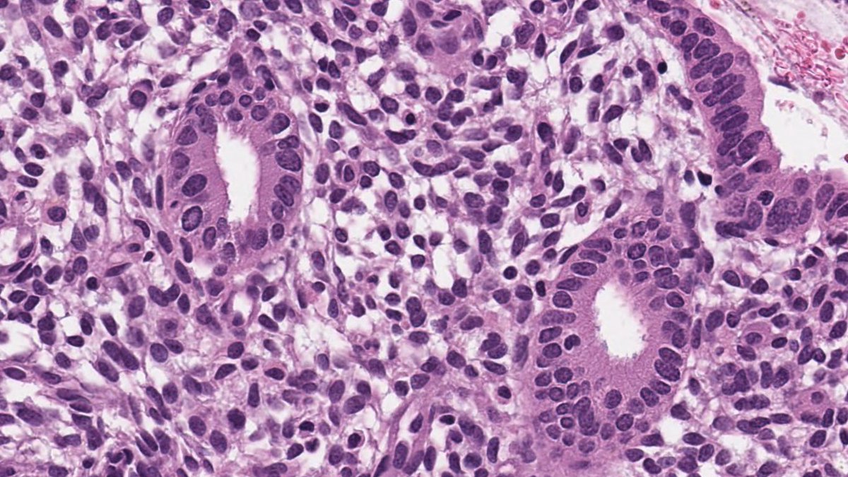 Drmerm's tweet photo. TUBAL ENDOMETRIOSIS
Endometriosis frequently involves the fallopian tube
it is seen in up to 10% of tubal resection specimens.
#PathTwitter #Medtwitter #pathology #gync https://t.co/eVToS6osHx