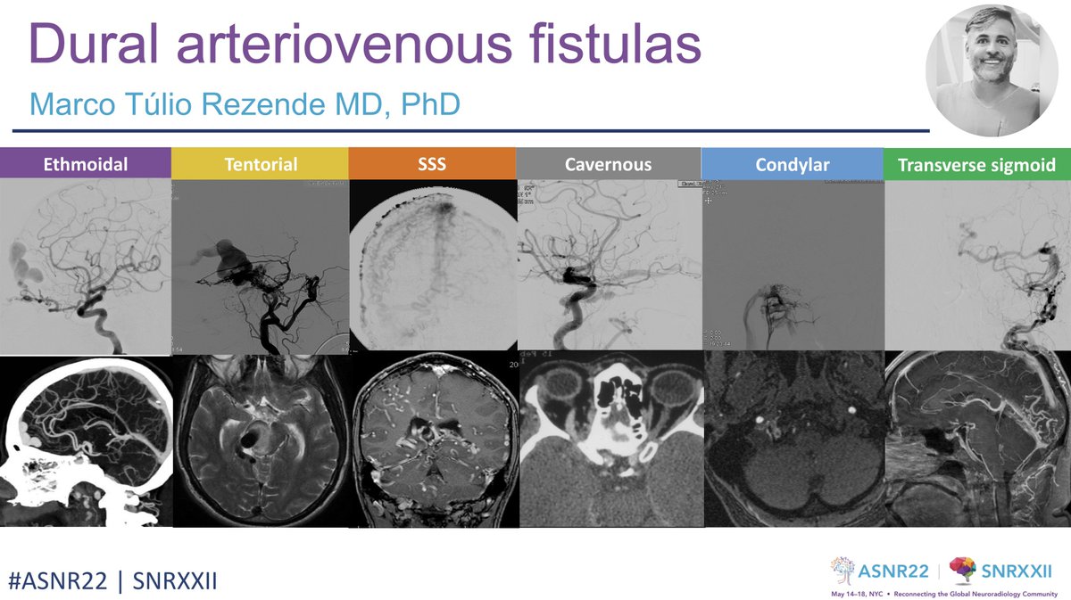 The American Society of Neuroradiology (@theasnr) on Twitter photo Imaging and management of dural arteriovenous shunts
🔸Learn more @ SNRXXII Interventional track sessions
🔸Time: 8:45 am to 10 am, 05/15/22
🔸Where: Beekman
🔸By: <a href="/mts_rezende/">Marco Túlio Salles Rezende</a>
#ASNR22 #SNRXXII #ASNR22Summaries
<a href="/theshadowfixer/">George Vilanilam</a> Imaging and management of dural arteriovenous shunts
🔸Learn more @ SNRXXII Interventional track sessions
🔸Time: 8:45 am to 10 am, 05/15/22
🔸Where: Beekman
🔸By: <a href="/mts_rezende/">Marco Túlio Salles Rezende</a>
#ASNR22 #SNRXXII #ASNR22Summaries
<a href="/theshadowfixer/">George Vilanilam</a>