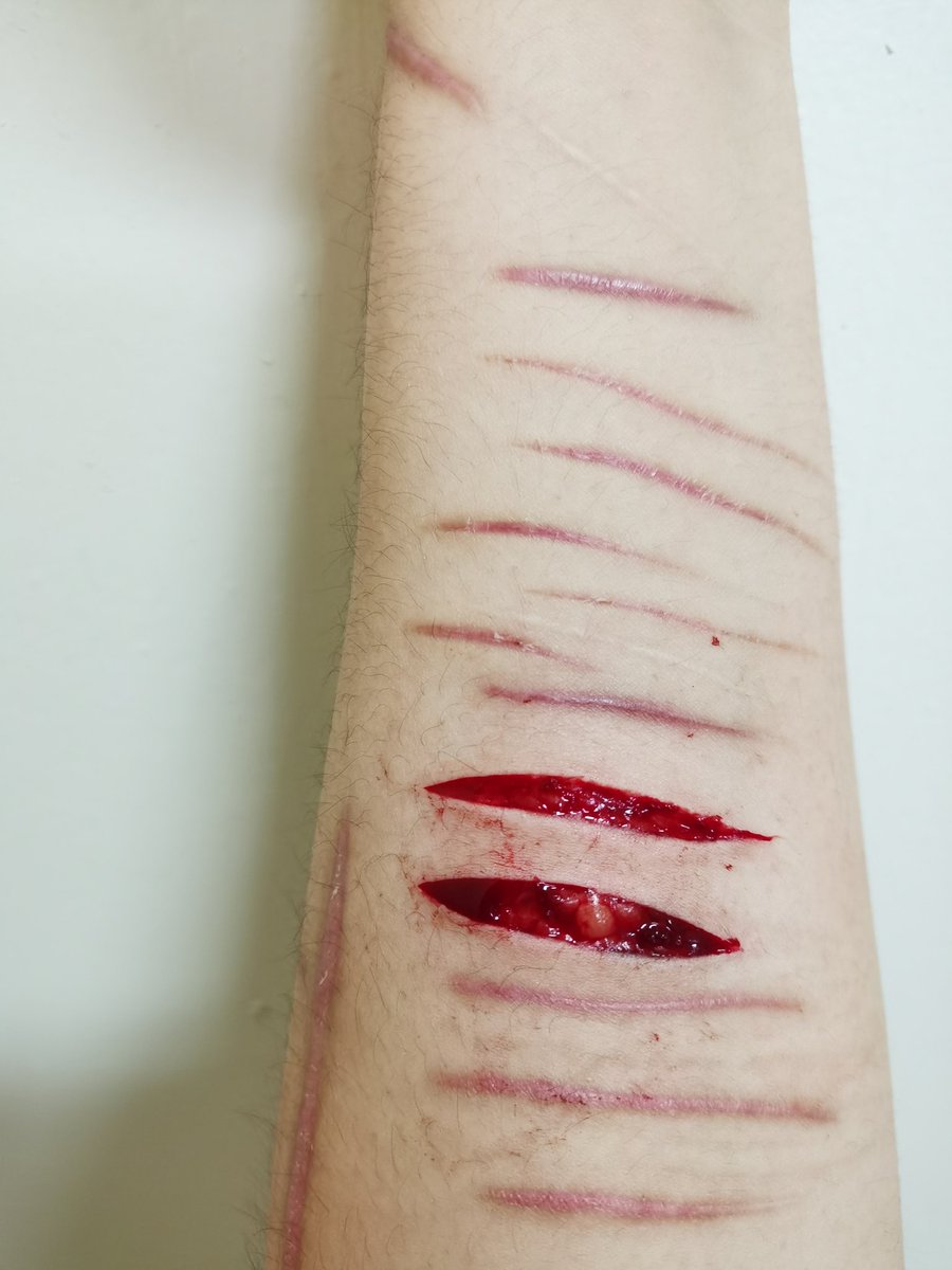 SOLITARYCORPSE's tweet photo. 5.14
左小臂。 https://t.co/X0FqvYNwod