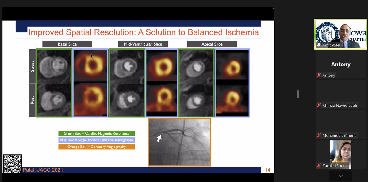 Antony Anandaraj (@antanee) on Twitter photo Happening now! Cardiac MRI in Ischemic Cardiomyopathy by Dr. Patel <a href="/AmitRPatelMD/">Amit R. Patel</a>
#ACCEarlyCareer #IowaACCLectures
<a href="/ACCinTouch/">American College of Cardiology</a>
<a href="/SCMRorg/">Society for Cardiovascular Magnetic Resonance</a>
<a href="/Heart_SCCT/">Heart_SCCT</a> Happening now! Cardiac MRI in Ischemic Cardiomyopathy by Dr. Patel <a href="/AmitRPatelMD/">Amit R. Patel</a>
#ACCEarlyCareer #IowaACCLectures
<a href="/ACCinTouch/">American College of Cardiology</a>
<a href="/SCMRorg/">Society for Cardiovascular Magnetic Resonance</a>
<a href="/Heart_SCCT/">Heart_SCCT</a>