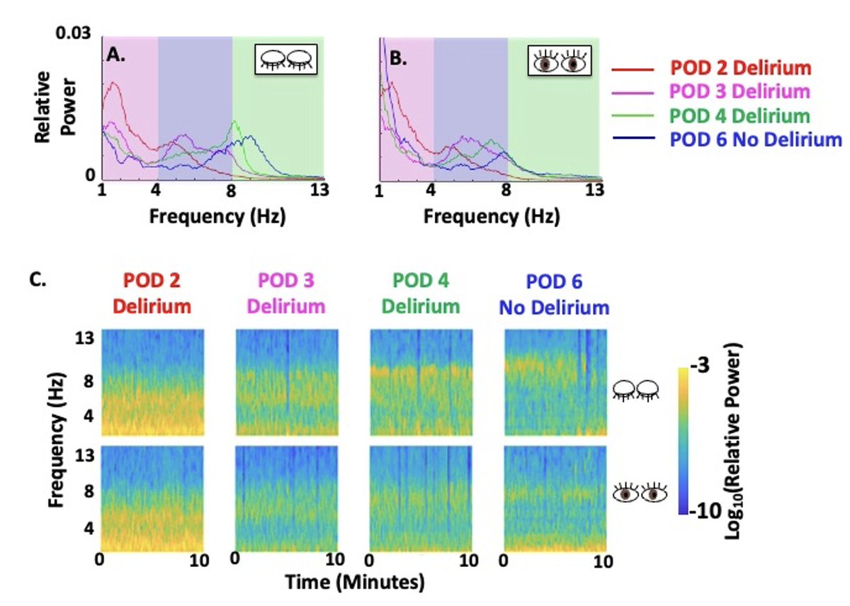 Christian S. Guay, MD (@christianguaymd) on Twitter photo Just published in <a href="/IARS_Journals/">Anesthesia&Analgesia</a>: "Postoperative Delirium Severity and Recovery Correlate With Electroencephalogram Spectral Features".
Another piece of the puzzle to quantify and track conscious states through time. <a href="/avidan_michael/">Michael Avidan</a> <a href="/WashUanesthesia/">WashU Medicine Anesthesiology</a>
tinyurl.com/yuasvmn4 Just published in <a href="/IARS_Journals/">Anesthesia&Analgesia</a>: "Postoperative Delirium Severity and Recovery Correlate With Electroencephalogram Spectral Features".
Another piece of the puzzle to quantify and track conscious states through time. <a href="/avidan_michael/">Michael Avidan</a> <a href="/WashUanesthesia/">WashU Medicine Anesthesiology</a>
tinyurl.com/yuasvmn4