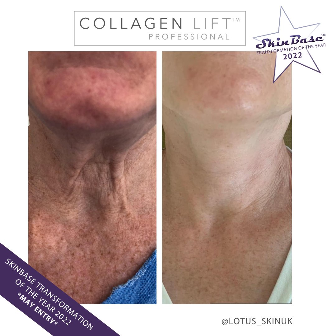 SkinBase_facial's tweet image. ⭐️ May transformation with this fabulous entry from Lotus Skin UK. These fantastic results were achieved through a 6 treatment course of Collagen Lift.

Click the link in our bio for your chance to Win a Holiday! #skinbase #collagenlift #transformation22