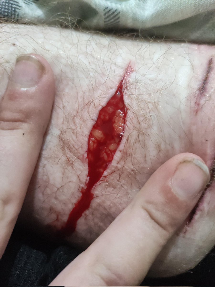 GonerKid4's tweet photo. Hit something kinda major with this one but it's just sooo pretty :((( excuse my nails btw, ik they're gross I got rid of them

Shtwt goretwt armgills raspberryfillingtwt styrotwt beanstwt sliceytwt ouchietwt catscratchtwt https://t.co/OlIGrhphMs