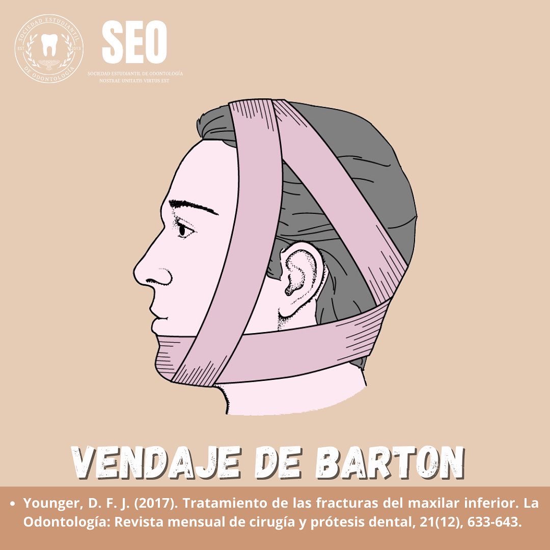 SEO_Unison's tweet photo. 🤕VENDAJE DE BARTON🤕

#OdontoBúhos https://t.co/0h3tYU6UaV