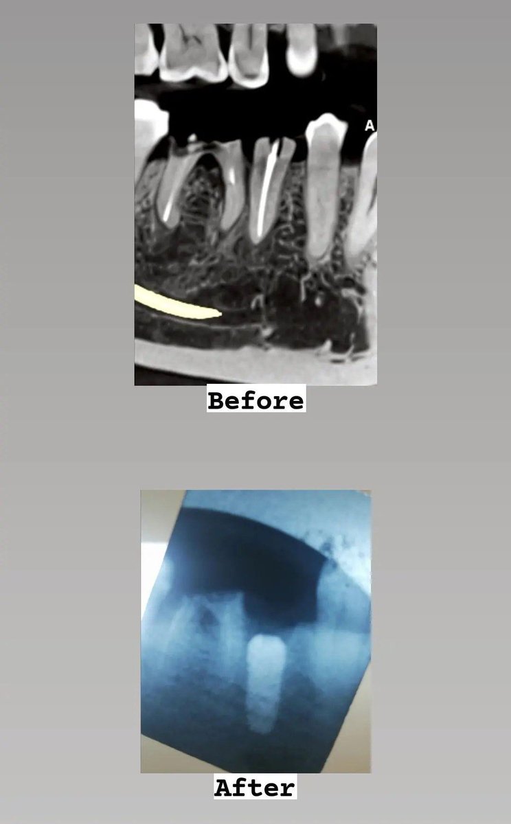 mustafaalaas's tweet photo. 2nd dental implant ⁦💪🏽⁩

At @DentoLearn clinic https://t.co/Cv78ib9C0I