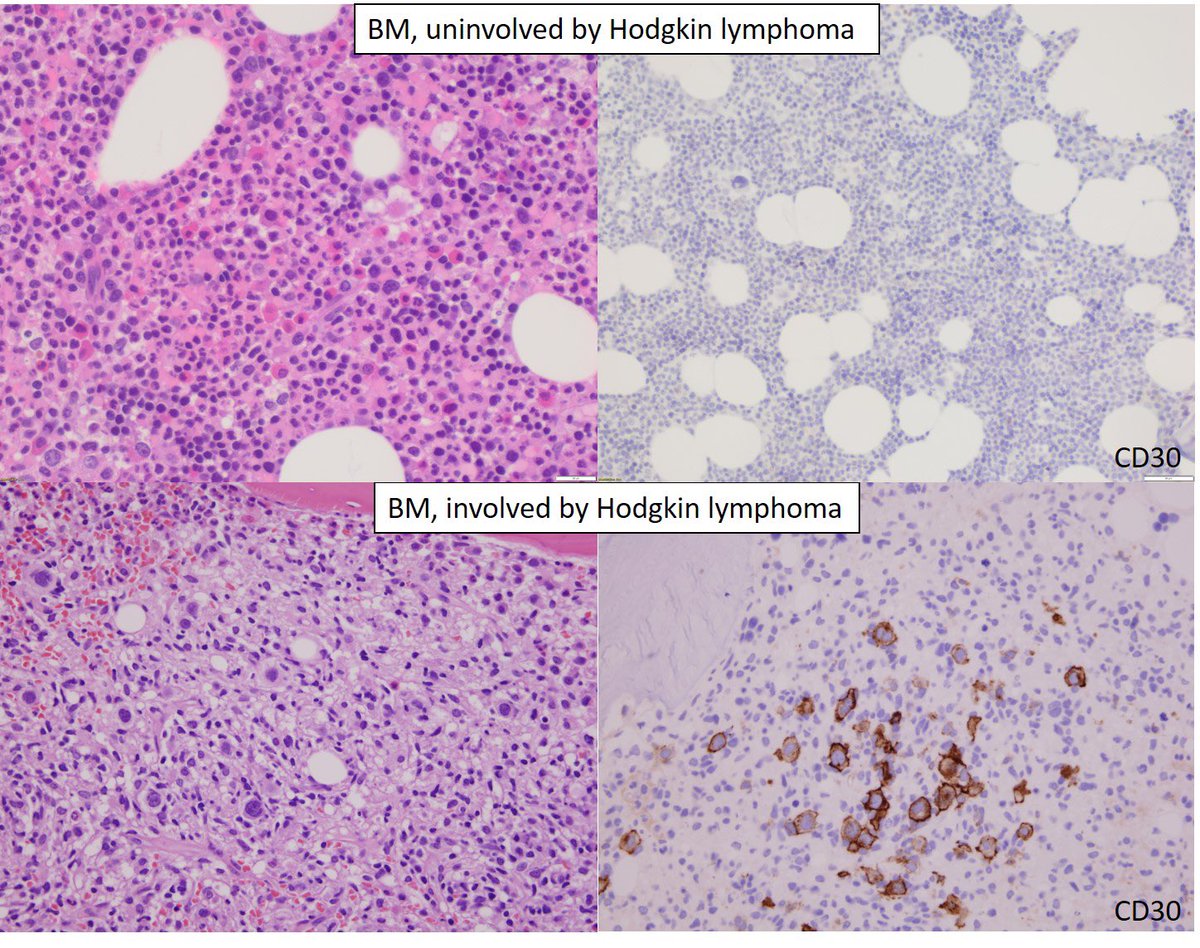 Staging BM can look scary in pts w/Hodgkin #lymphoma, even if uninvolved,b/c there is often paraneoplastic granulocytic,eosinophilic &amp; plasma cell hyperplasia, but fear not, Hodgkin in BM isn’t subtle:U know it when U see it😉see👇🏻examples: both pts had Hodgkin lymphoma #hemepath