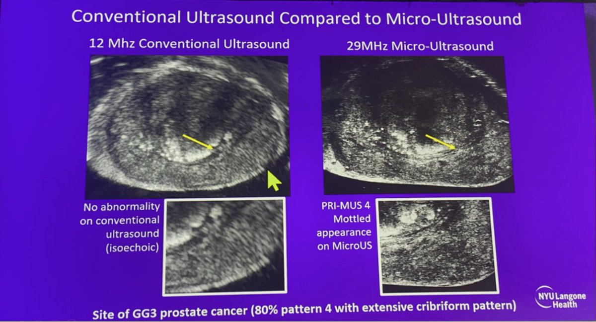 UroToday.com (@urotoday) on Twitter photo Best Prostate Biopsy Techniques in 2022. Presentation by <a href="/DanBarocas/">Daniel Barocas</a> <a href="/VUMCurology/">Vanderbilt Urology</a>, <a href="/arvinkgeorge/">Arvin K. George, MD</a> <a href="/UMichUrology/">Michigan Urology</a>, <a href="/benristau/">Ben Ristau, MD MHA</a> <a href="/UConnUrology/">UConn Urology</a>, <a href="/Scarps_kristen/">Kristen R. Scarpato</a>, and <a href="/tanejauro/">Samir Taneja</a> <a href="/nyulangone/">NYU Langone Health</a>. #AUA22 written coverage by @rksayyid <a href="/mcg_urology/">MCG Urology</a> > bit.ly/3lc4sMg <a href="/AmerUrological/">Amer. Urol. Assn.</a> Best Prostate Biopsy Techniques in 2022. Presentation by <a href="/DanBarocas/">Daniel Barocas</a> <a href="/VUMCurology/">Vanderbilt Urology</a>, <a href="/arvinkgeorge/">Arvin K. George, MD</a> <a href="/UMichUrology/">Michigan Urology</a>, <a href="/benristau/">Ben Ristau, MD MHA</a> <a href="/UConnUrology/">UConn Urology</a>, <a href="/Scarps_kristen/">Kristen R. Scarpato</a>, and <a href="/tanejauro/">Samir Taneja</a> <a href="/nyulangone/">NYU Langone Health</a>. #AUA22 written coverage by @rksayyid <a href="/mcg_urology/">MCG Urology</a> > bit.ly/3lc4sMg <a href="/AmerUrological/">Amer. Urol. Assn.</a>