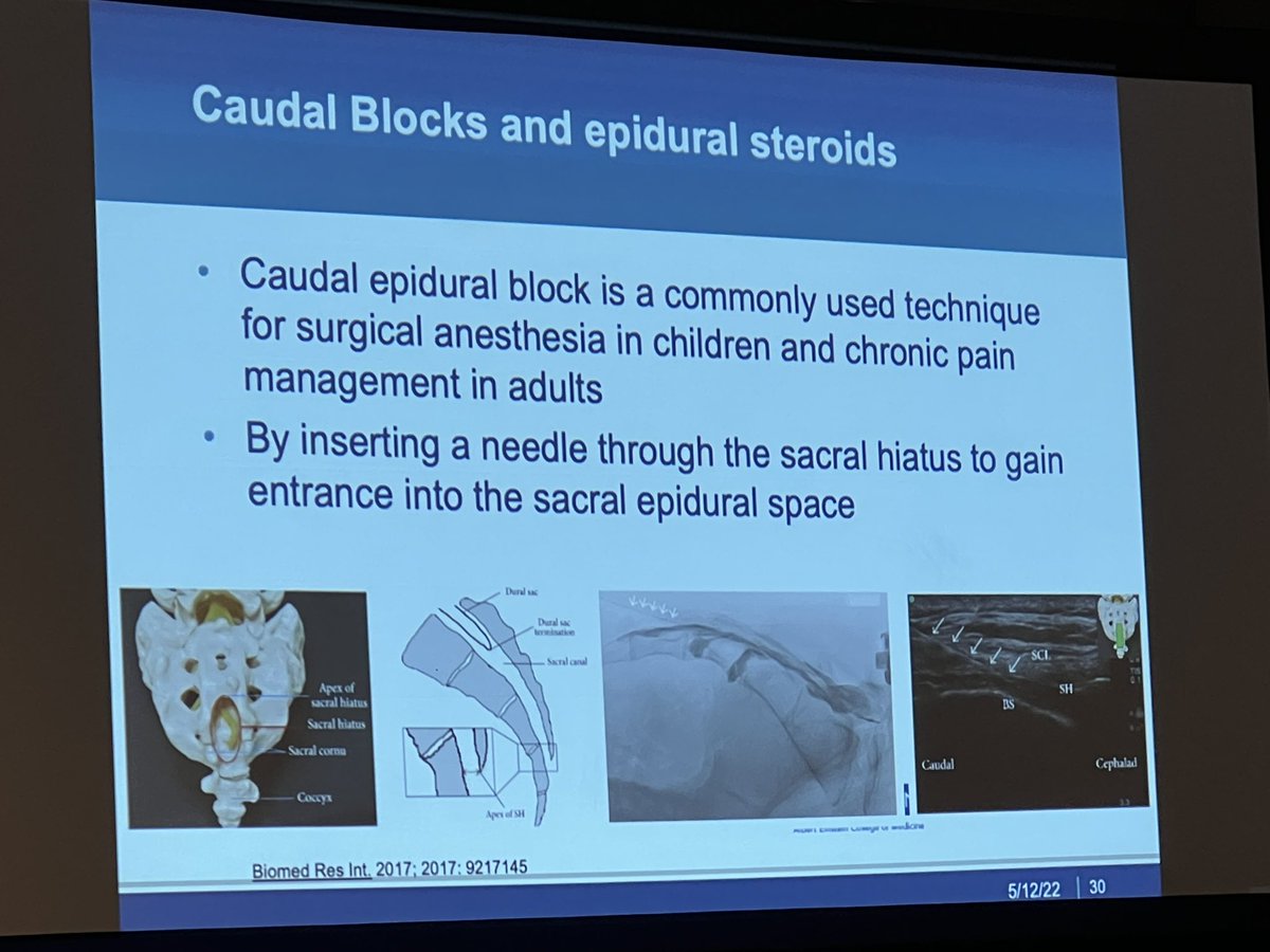 American Society of Spine Radiology (ASSR) (@the_assr) on Twitter photo Treatments of coccydynia reviewed by <a href="/AllanLBrookMD/">Allan Brook</a>
#SNRXXII #ASNR22 <a href="/vinil_shah/">Vinil Shah</a> <a href="/jlgomd/">John L. Go</a> <a href="/LubdhaShah/">Lubdha Shah</a> <a href="/JackASSR23/">Jack Jennings, MD, PhD</a> <a href="/KSeifertMD/">Kim Seifert, MD, MS</a> <a href="/radiology_ninja/">Ichiro Ikuta, MD, MMSc</a> <a href="/OrmsbyMD/">Jacob Ormsby, MD, MBA</a> Treatments of coccydynia reviewed by <a href="/AllanLBrookMD/">Allan Brook</a>
#SNRXXII #ASNR22 <a href="/vinil_shah/">Vinil Shah</a> <a href="/jlgomd/">John L. Go</a> <a href="/LubdhaShah/">Lubdha Shah</a> <a href="/JackASSR23/">Jack Jennings, MD, PhD</a> <a href="/KSeifertMD/">Kim Seifert, MD, MS</a> <a href="/radiology_ninja/">Ichiro Ikuta, MD, MMSc</a> <a href="/OrmsbyMD/">Jacob Ormsby, MD, MBA</a>