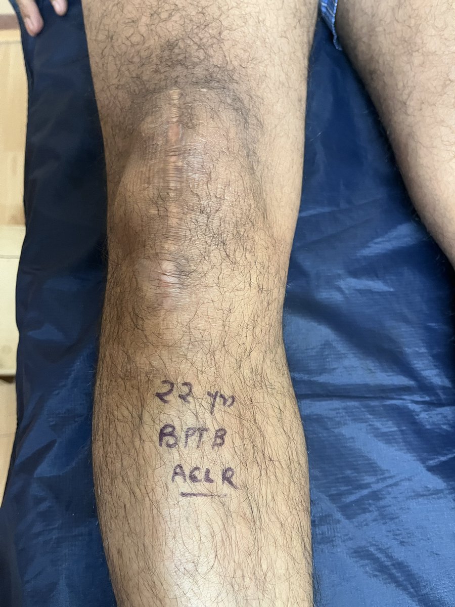 drnvss's tweet photo. #aclreconstruction #pclreconstruction #knee #aclrecovery #aash For Knee ligament reconstruction, to me still BPTB graft is a gold standard. Front knee pain is very rare. This is 22 years after BPTB reconstruction who cycles 20 kms or runs 10 kms. - alternate day/week https://t.co/LaoG97pWLs