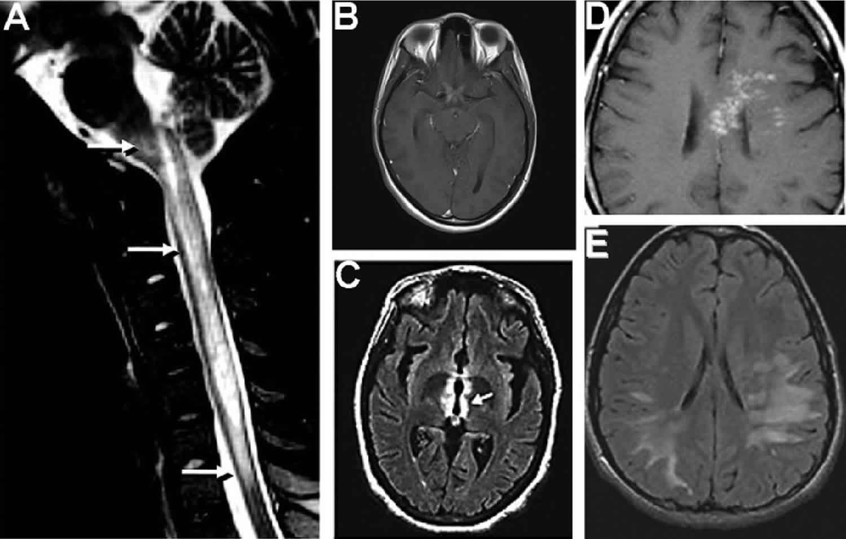 EyeFlyMD's tweet photo. Ophthalmology Eponym of the Week: Devic's Disease, or Nueromyelitis Optica, should be suspected when optic neuritis that fails to recover on steroids. Demyelination can be more posterior and accompanied by changes in the spinal chord.
#ophthalmology #ophthotwitter #medtwitter https://t.co/Twrb7gAHna