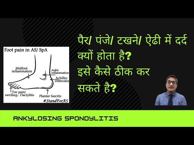 doctorakerkar's tweet image. Ankylosing spondylitis की वजह से पैर/ पंजा/ टखने/ ऐढी में दर्द क्यों होता है?
youtu.be/R5LustFYuY8
#AnkylosingSpondylitis #AxSpA