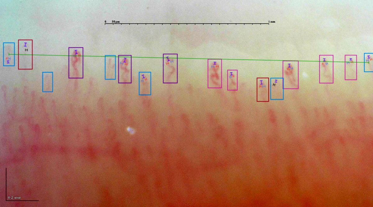 gmaldonadovelez's tweet photo. Experiencing G-Scope Capillaroscopy๐จ
Normal pattern in healthy subject ๐ก
Capillaryio software ๐ฑ on point ๐
More ๐ธ to come!
A peak of subpapillar venous plexus ๐
#Capillaryio #Capillaroscopy #MedTwitter #RheumTwitter https://t.co/ZnsNL0hGRT