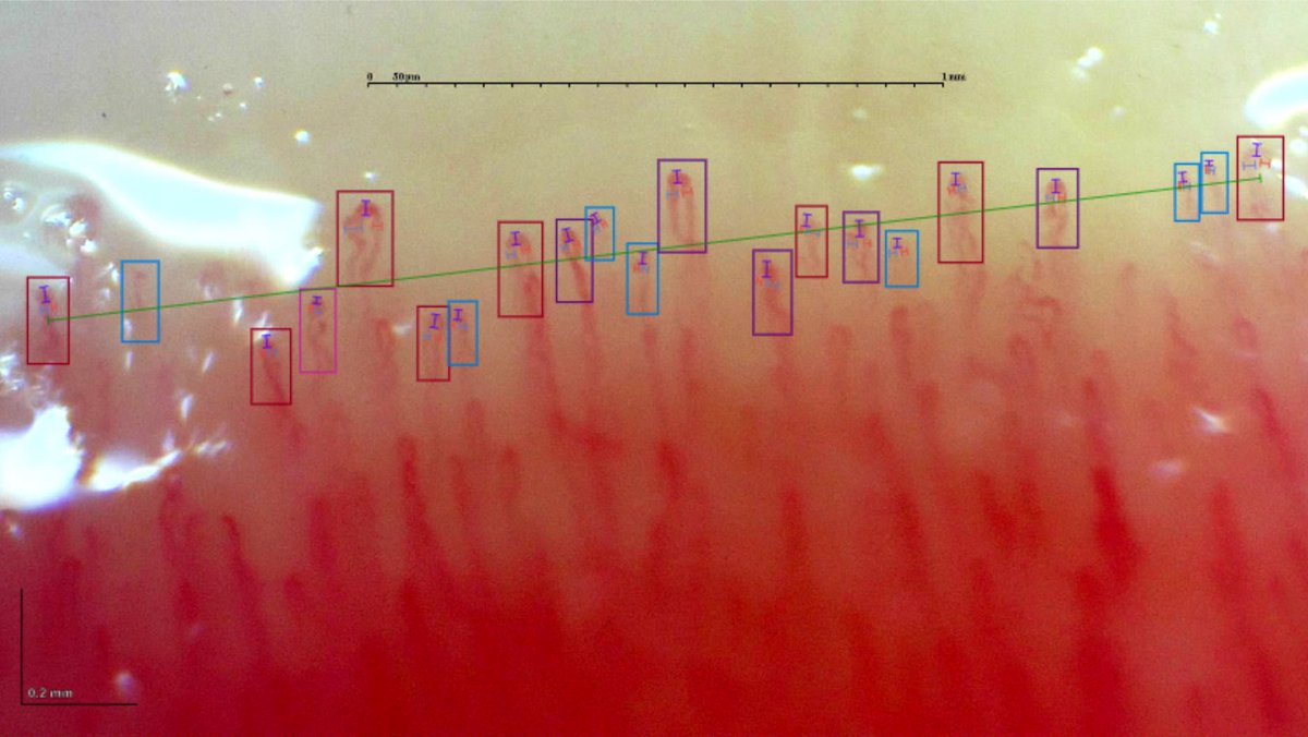gmaldonadovelez's tweet photo. Experiencing G-Scope Capillaroscopy๐จ
Normal pattern in healthy subject ๐ก
Capillaryio software ๐ฑ on point ๐
More ๐ธ to come!
A peak of subpapillar venous plexus ๐
#Capillaryio #Capillaroscopy #MedTwitter #RheumTwitter https://t.co/ZnsNL0hGRT