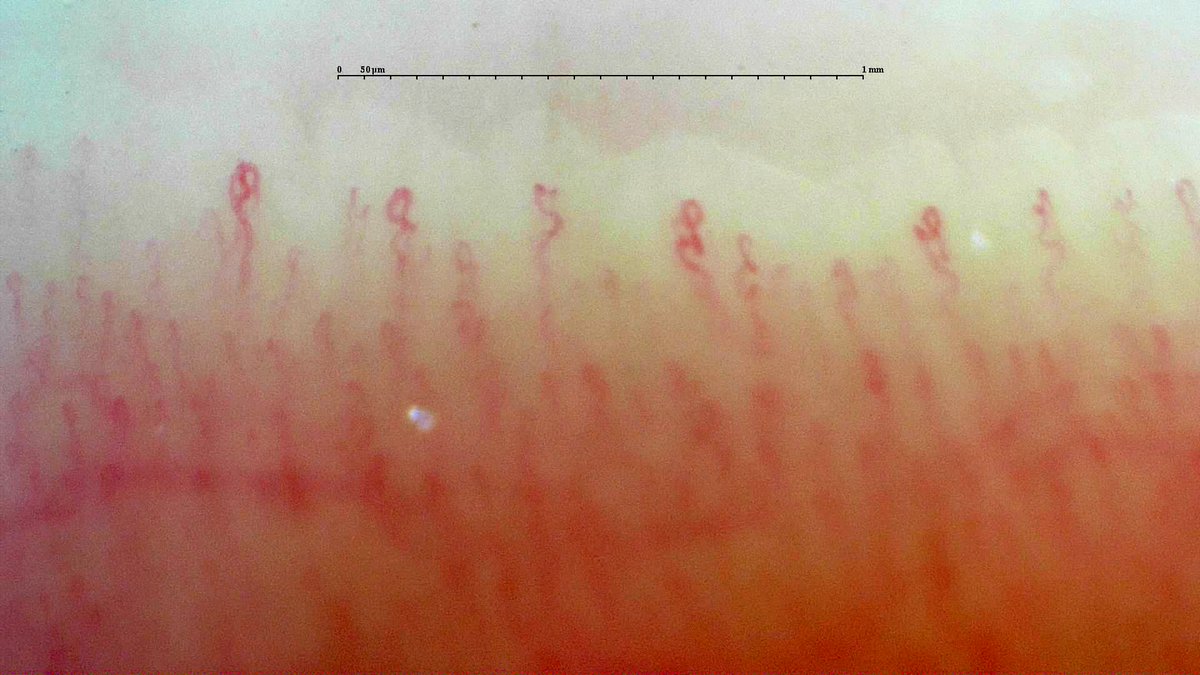 gmaldonadovelez's tweet photo. Experiencing G-Scope Capillaroscopy๐จ
Normal pattern in healthy subject ๐ก
Capillaryio software ๐ฑ on point ๐
More ๐ธ to come!
A peak of subpapillar venous plexus ๐
#Capillaryio #Capillaroscopy #MedTwitter #RheumTwitter https://t.co/ZnsNL0hGRT
