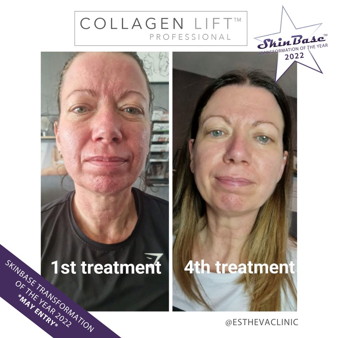SkinBase_facial's tweet image. ⭐️ May transformation with this fabulous entry from Estheva Clinic. These fantastic results were achieved through a 4 treatment course of Collagen Lift.  

Click the link in our bio for your chance to Win a Holiday! #skinbase #collagenlift #transformation22