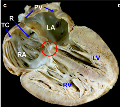 Our #heart has a left and a right atrium, and a left and a right ventricle = 4 chambers. Why not 5, 6 or 7 chambers? Hypothetical Q perhaps, but the embryo actually forms heart muscle beyond the 4 chambers, namely in the systemic and pulmonary veins and the outflow tract. A 🧵