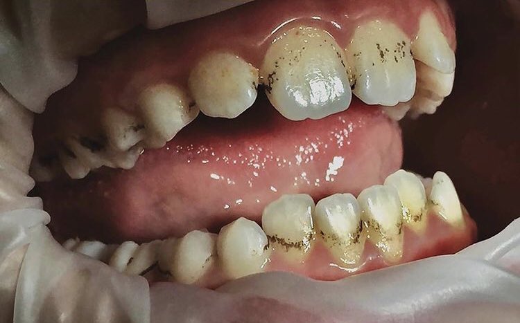drflossa's tweet photo. 30min Scaling Procedure. https://t.co/AJhv4F3a6M
