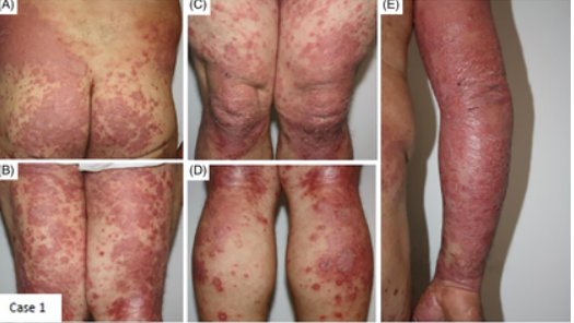 AdverseReports's tweet photo. Exacerbation of plaque psoriasis after #Sinovac inactivated and #Pfzer BNT162b2 mRNA vaccines A report of two cases
https://t.co/dsjjjKG98e https://t.co/OkY3IyYEhm