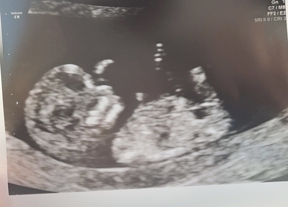 starrcoutts's tweet photo. One week today and we find out if your a girl or boy🙊💗💙 https://t.co/PerduPPgcR