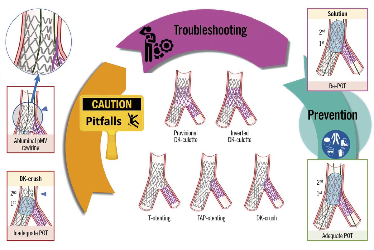 KardiologieHH's tweet photo. 🚨Hot of the press🚨
16th Expert Consensus Document of the European Bifurcation Club 

➡️Part 1 - on the provisional pathway:
🔗https://t.co/7kdkJ2sivM

➡️Part 2 - on two-stent strategies:
🔗https://t.co/gI8Pj9AFft

#EuroPCR @PCRonline https://t.co/6oDfhArIuq
