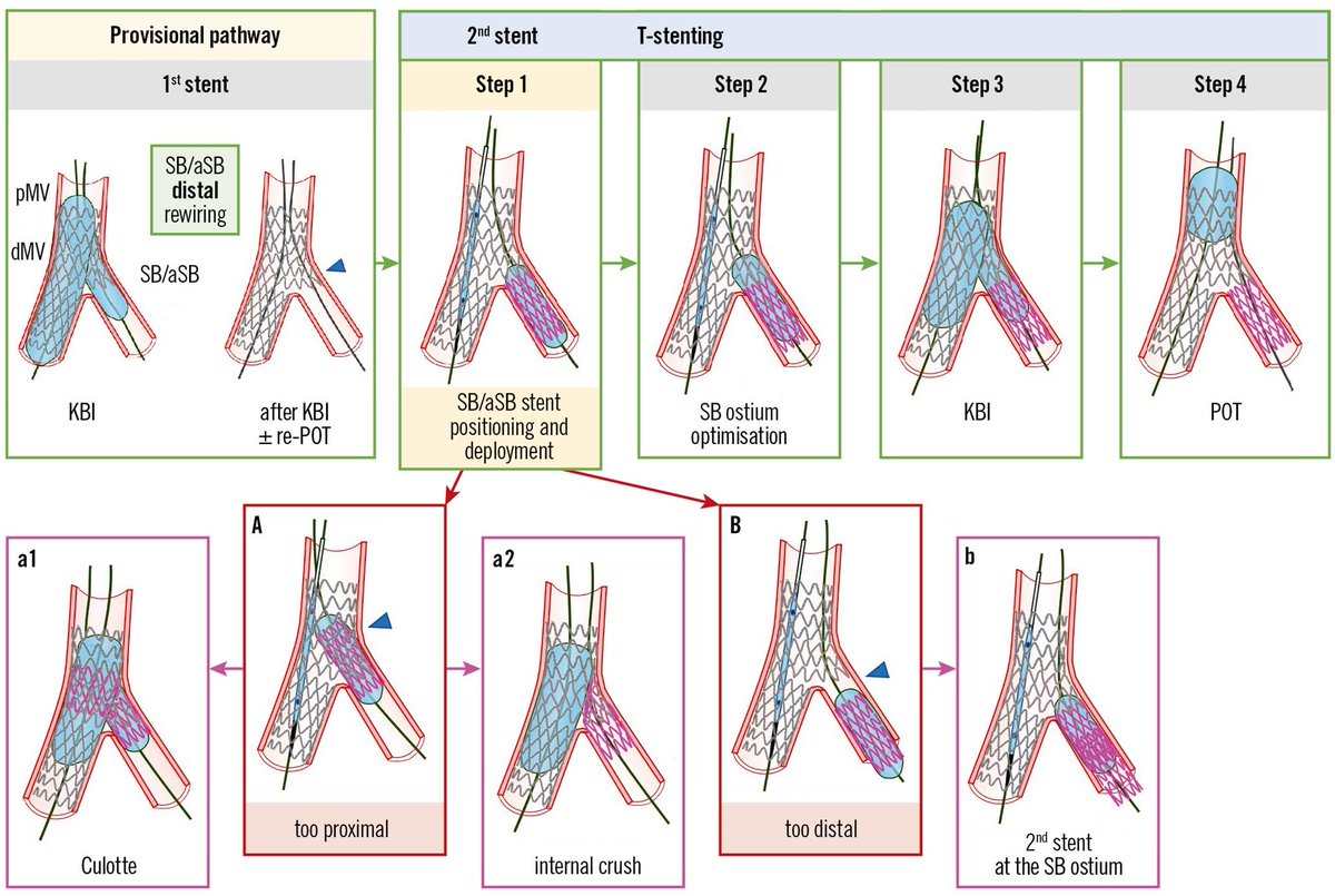 KardiologieHH's tweet photo. 🚨Hot of the press🚨
16th Expert Consensus Document of the European Bifurcation Club 

➡️Part 1 - on the provisional pathway:
🔗https://t.co/7kdkJ2sivM

➡️Part 2 - on two-stent strategies:
🔗https://t.co/gI8Pj9AFft

#EuroPCR @PCRonline https://t.co/6oDfhArIuq