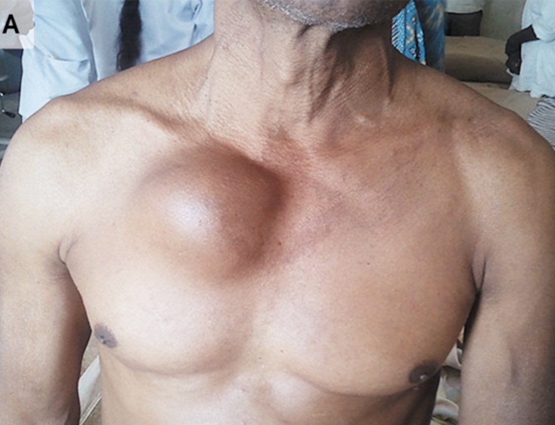 AvrahamCooperMD's tweet photo. Pulsatile chest swelling ➡️ HUGE aortic aneurysm from tertiary syphilis 

#MedTwitter https://t.co/xtAfjytSkv
