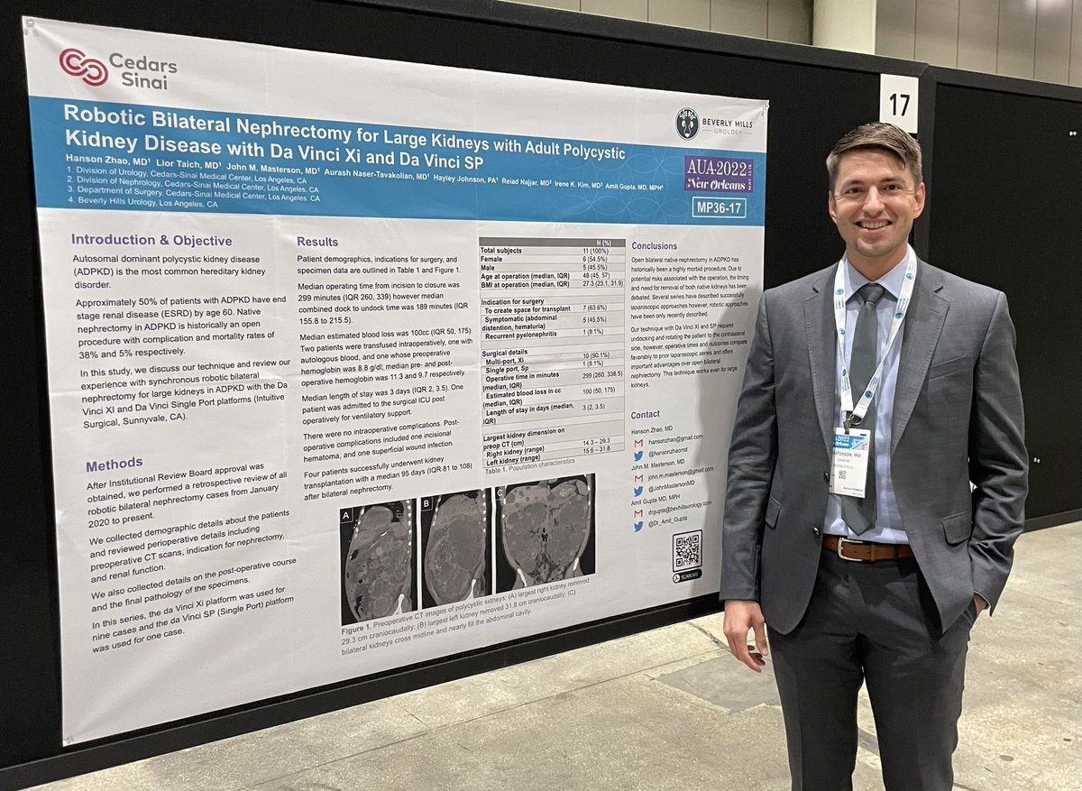 Department of Urology at Cedars-Sinai (@cs_urology) on Twitter photo Grateful for the opportunity to present our work at #AUA22. Robotic bilateral nephrectomy for patients with large polycystic kidneys is feasible and offers advantages over traditional open nephrectomy in terms of blood loss, LOS, and overall morbidity/ morality. <a href="/Dr_Amit_Gupta/">Amit Gupta MD</a> Grateful for the opportunity to present our work at #AUA22. Robotic bilateral nephrectomy for patients with large polycystic kidneys is feasible and offers advantages over traditional open nephrectomy in terms of blood loss, LOS, and overall morbidity/ morality. <a href="/Dr_Amit_Gupta/">Amit Gupta MD</a>