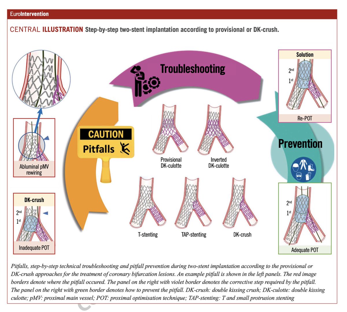 16th Expert Consensus Document of the European Bifurcation Club: for both Provisional (eurointervention.pcronline.com/article/treatm…) and up-front 2-Stent (eurointervention.pcronline.com/article/treatm…) strategies🤜🤛…