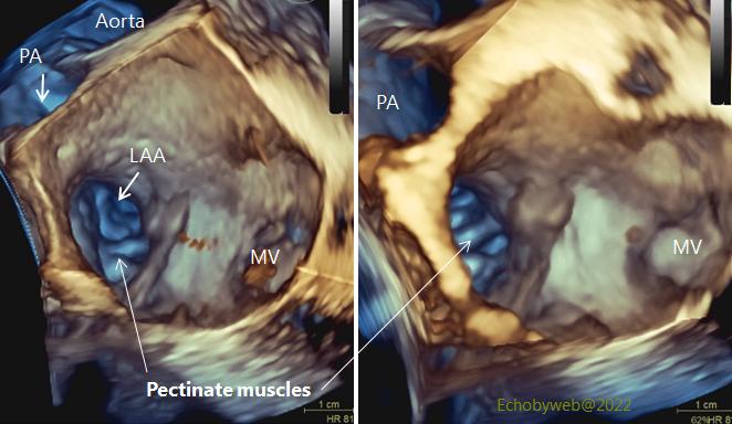echobyweb's tweet image. New TE Atlas page: 3D anatomy of left atrium and appendage. In: echobyweb.com/homepage/atlas…
#CardioTwitter #cvImaging #cvEcho #echofirst #cardiology #methodology #transesophageal #leftatrium #leftappendage