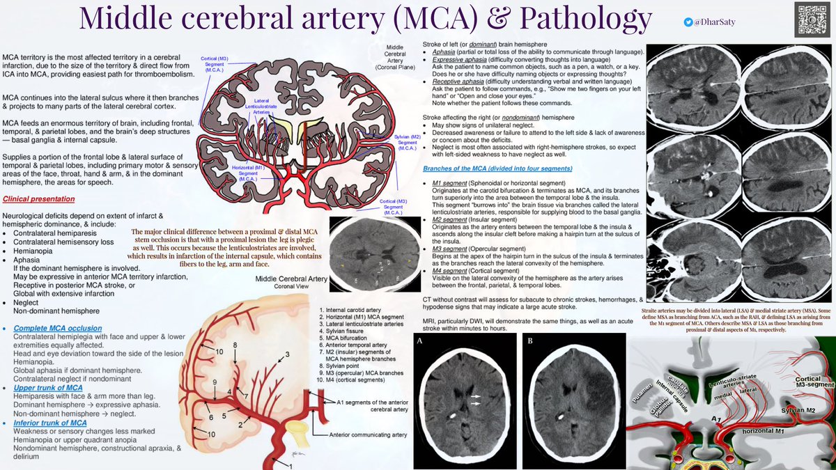 Middle cerebral artery (MCA):
MCA territory is the most commonly affected territory in a cerebral infarction, due to the size of the territory &amp; the direct flow from ICA into MCA, providing the easiest path for thromboembolism.
<a href="/grepmeded/">GrepMed</a> #MedEd #MedTwitter #MedStudentTwitter 
👇