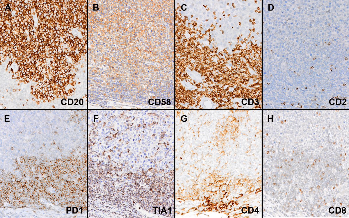FVega957's tweet photo. CD2-negative lymphoma-associated T-cells: a potential mechanism of immune-evasion in diffuse large B-cell lymphoma
https://t.co/1VeevnJakK
https://t.co/McQH53ud8U
#lymphsm #lymphoma #hemapath https://t.co/C9vPavDRES