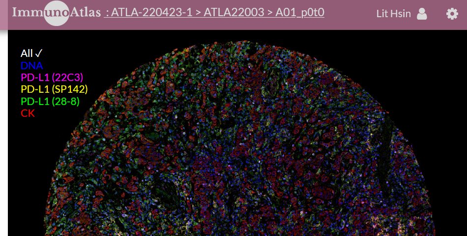 LitHsinLoo's tweet photo. cellXpress, our next-generation spatial profiling software for tissue images, was used to evaluate PD-L1 IHC assays for gastric cancer immunotherapy. Checkout the poster @ASCO and joint paper #GastricCancer next week. Full images hosted @immunoatlas (https://t.co/hqQJqhs5LF) https://t.co/6UUyM5uQIc