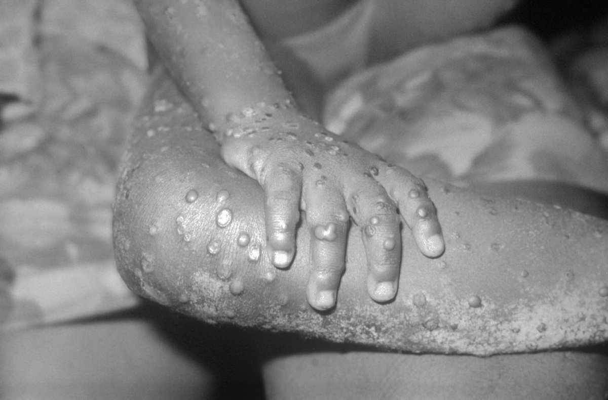 EBmedicine's tweet photo. #Monkeypox. A brief summary of what you need to know if you work in the emergency department. 

https://t.co/3qoJTyL7Sz #Emplify #foamed https://t.co/BtOLFMjPzx