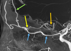 eytanraz's tweet photo. ๐๐ง #moyamoya Olfactory Rete can be understood in details using cone beam CT angiography #CBCT #DynaCT Drawing from Kamo et al 2019. #BANANA2022 Oct31-Nov2 https://t.co/wx5R36ibQX