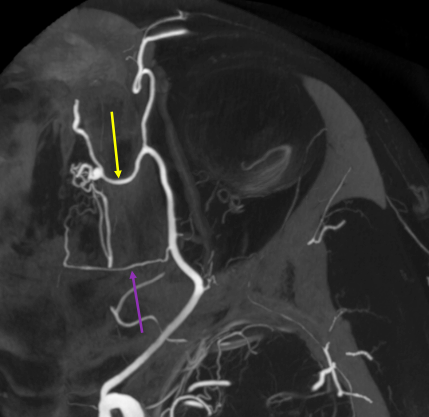 eytanraz's tweet photo. ๐๐ง #moyamoya Olfactory Rete can be understood in details using cone beam CT angiography #CBCT #DynaCT Drawing from Kamo et al 2019. #BANANA2022 Oct31-Nov2 https://t.co/wx5R36ibQX