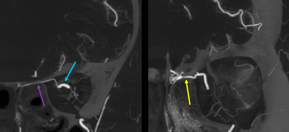 eytanraz's tweet photo. ๐๐ง #moyamoya Olfactory Rete can be understood in details using cone beam CT angiography #CBCT #DynaCT Drawing from Kamo et al 2019. #BANANA2022 Oct31-Nov2 https://t.co/wx5R36ibQX