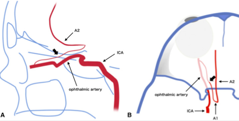 eytanraz's tweet photo. ๐๐ง #moyamoya Olfactory Rete can be understood in details using cone beam CT angiography #CBCT #DynaCT Drawing from Kamo et al 2019. #BANANA2022 Oct31-Nov2 https://t.co/wx5R36ibQX