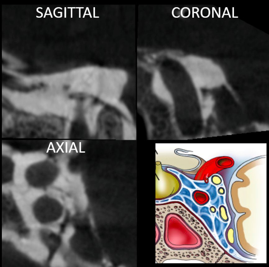 eytanraz's tweet photo. ๐๐ง Learning cavernous sinus anatomy from #dynaCT in patient with #CCF Negative image of the nerves coursing through the #CavSinus @neuroangio1 @ENossek #BANANA2022 (Drawing from Demerdash et al 2020) https://t.co/SL5GrnkDh9