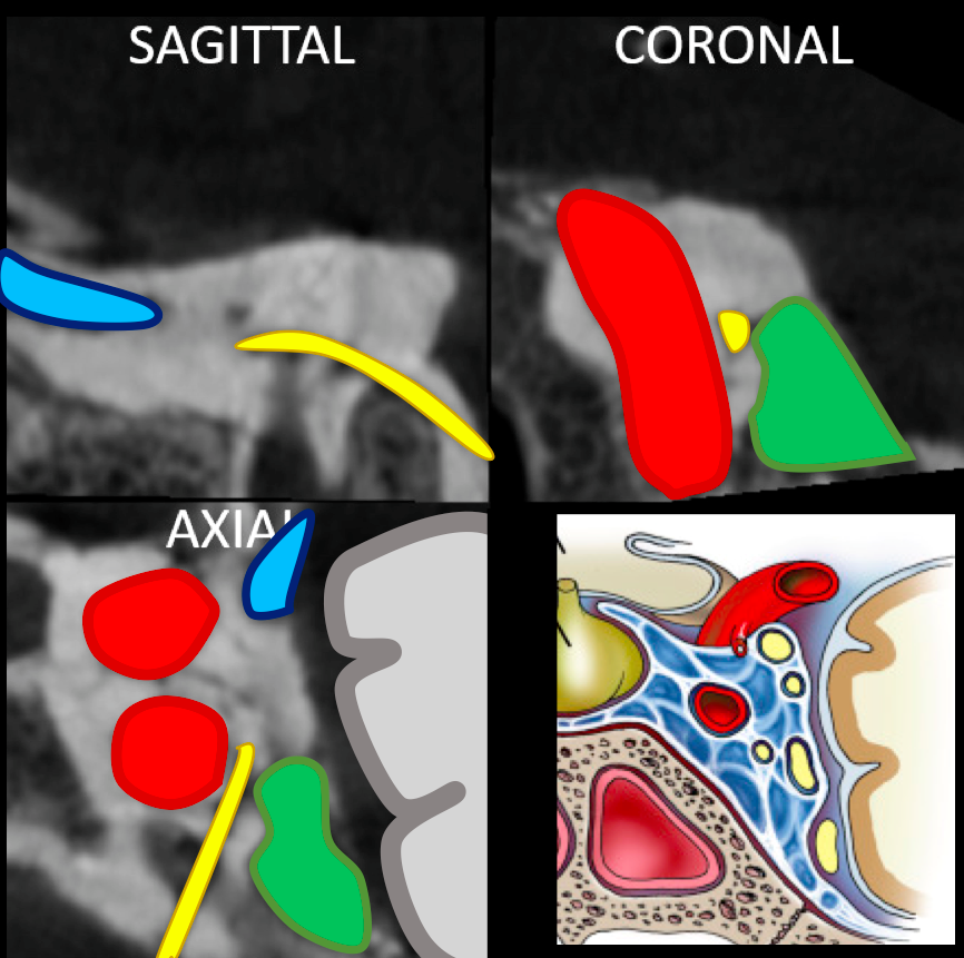 eytanraz's tweet photo. ๐๐ง Learning cavernous sinus anatomy from #dynaCT in patient with #CCF Negative image of the nerves coursing through the #CavSinus @neuroangio1 @ENossek #BANANA2022 (Drawing from Demerdash et al 2020) https://t.co/SL5GrnkDh9