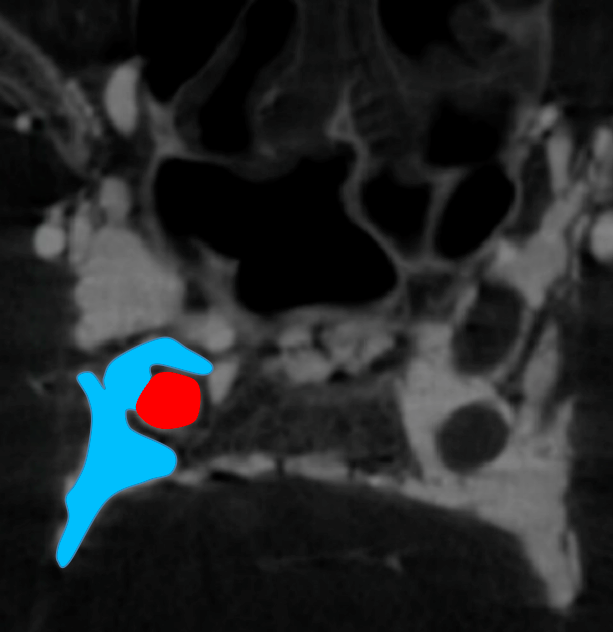 eytanraz's tweet photo. ๐๐ง Learning cavernous sinus anatomy from #dynaCT in patient with #CCF Negative image of the nerves coursing through the #CavSinus @neuroangio1 @ENossek #BANANA2022 (Drawing from Demerdash et al 2020) https://t.co/SL5GrnkDh9