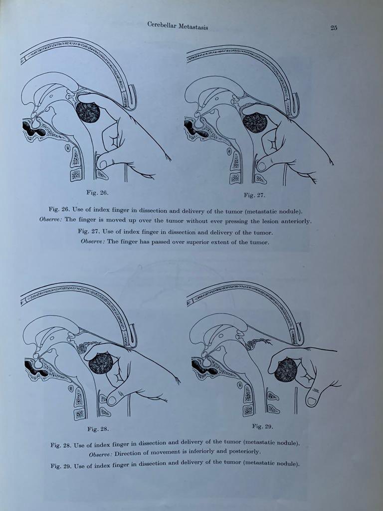 OGdukeneurosurg's tweet photo. As a #neurosurgery resident, you are instructed to have an instrument in each hand at all times, but prior to this rule  there was the classic one-finger resection of Mets. https://t.co/FsFX56D6uO