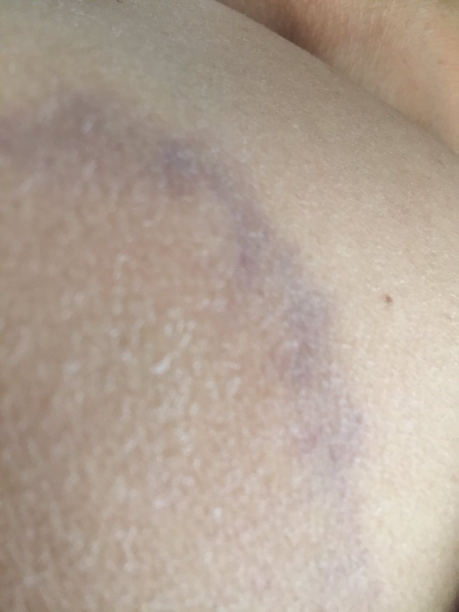 LouiseChild1's tweet photo. #WorldBloodCancerDay #SpotLeukaemia this is one of my actual bruises, often they can feel lumpy to touch too. https://t.co/k0Q70dY3t2