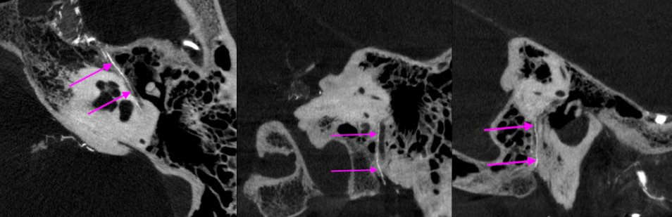 eytanraz's tweet photo. #FacialArterialArcade is in hemodynamic balance between #MMA petrosal branch and #OccipitalArtery Stylomastoid branch. Enjoy this #dynaCT full representation of its course. Credit @LydiaJGregg for the drawing (from Chen et al 2011). https://t.co/7dSkce1kqn